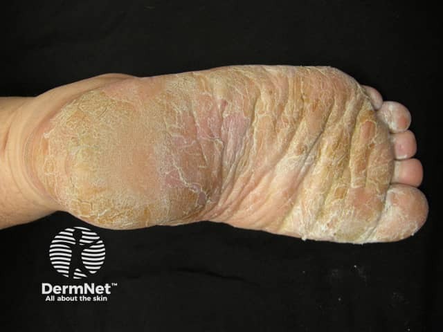 Palmoplantar psoriasis