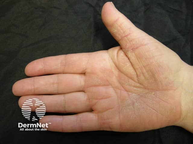 Palmar plaque psoriasis