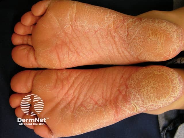 Palmoplantar psoriasis