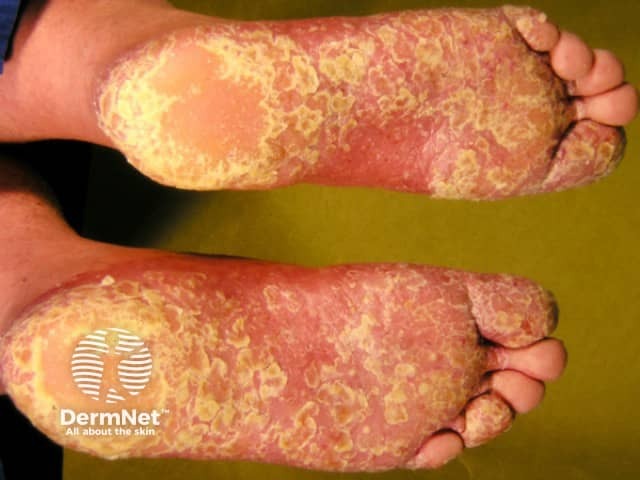 Palmoplantar psoriasis