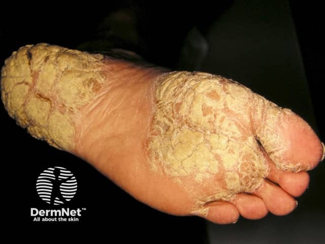 Palmoplantar psoriasis