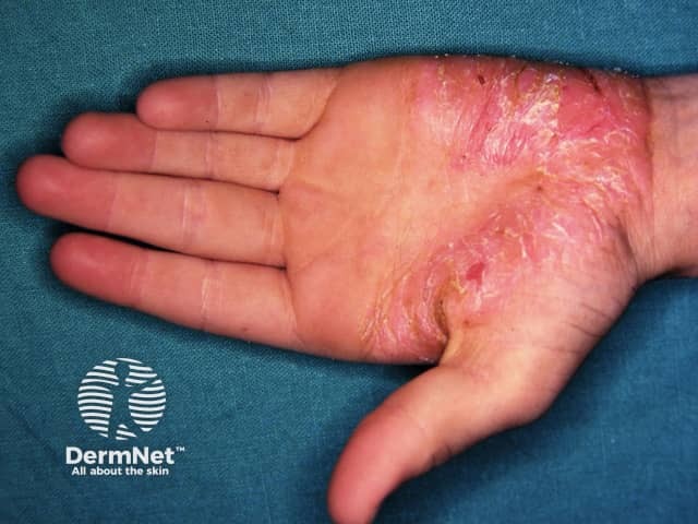 Palmoplantar psoriasis