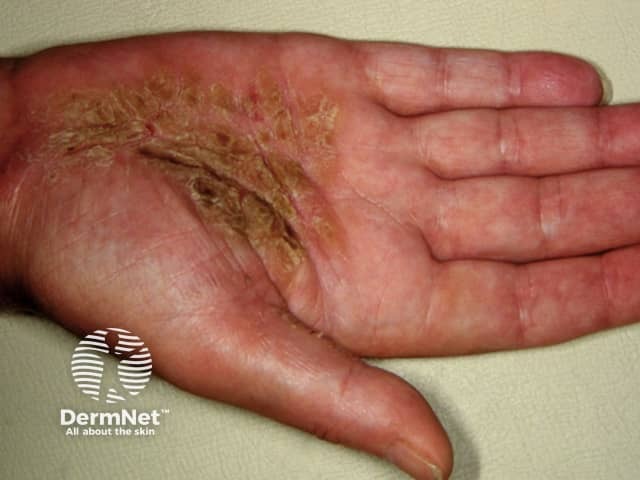 Palmoplantar psoriasis