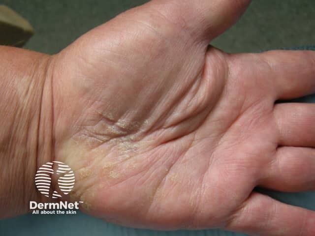 Palmoplantar psoriasis