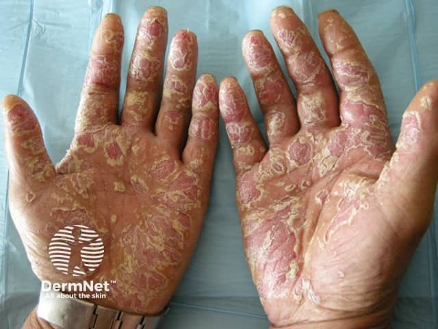 Palmoplantar psoriasis