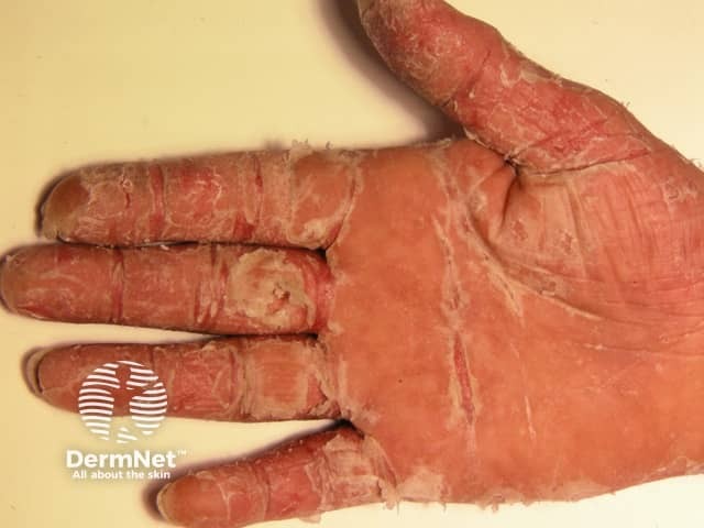 Palmoplantar psoriasis