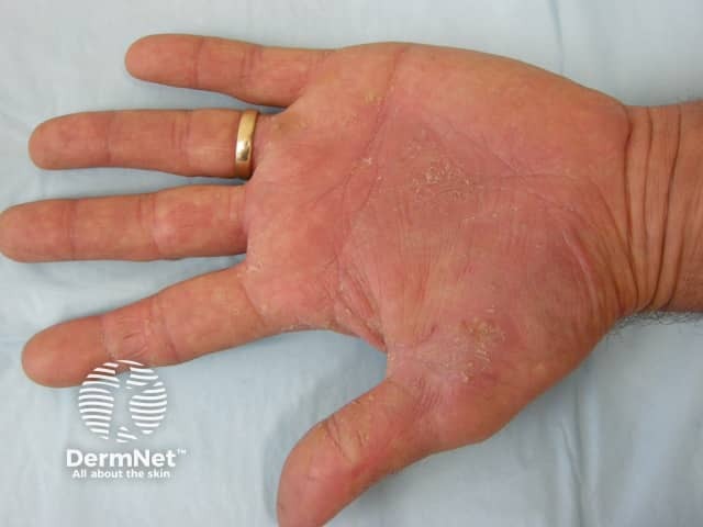 Palmoplantar psoriasis