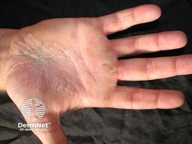 Palmoplantar psoriasis