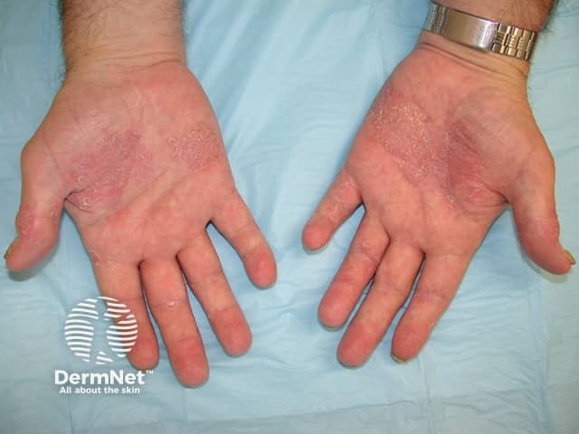 Palmoplantar psoriasis