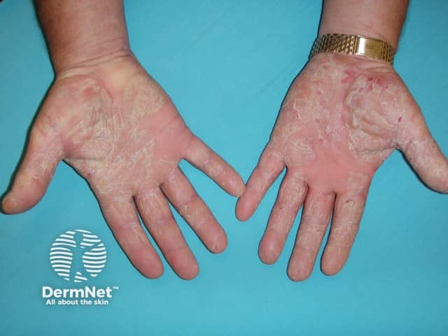 Palmoplantar psoriasis