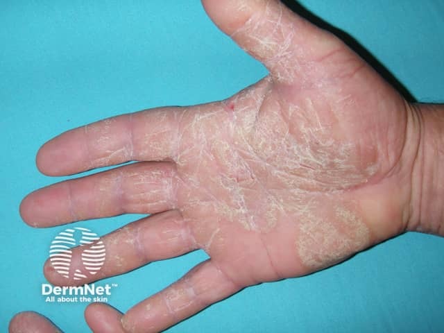 Palmoplantar psoriasis