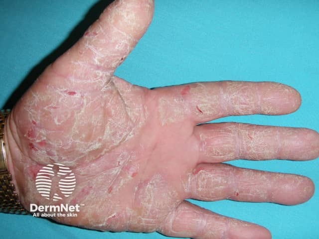 Palmoplantar psoriasis