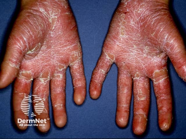 Pityriasis rubra pilaris