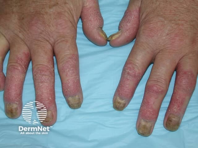 Psoriatic arthritis