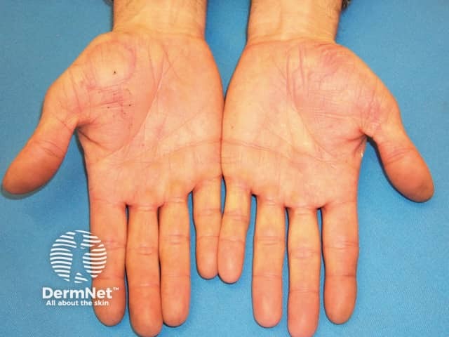 Palmar psoriasis