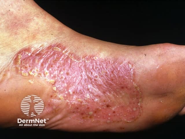 Palmoplantar pustulosis