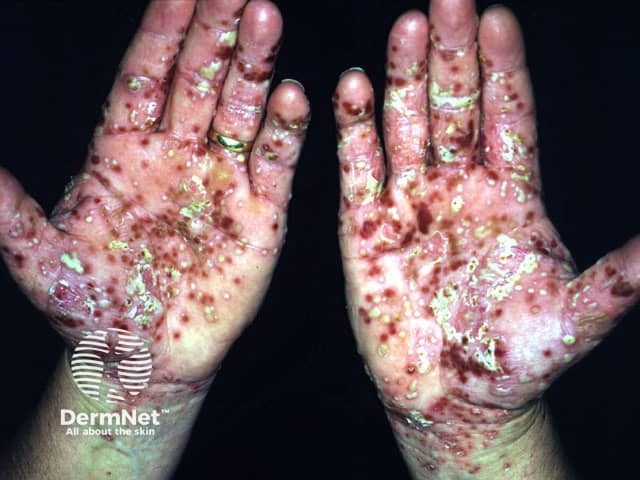 Palmoplantar pustulosis