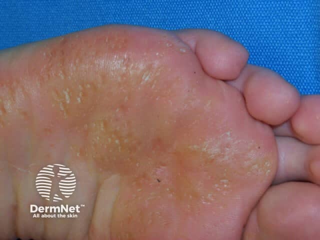 Punctate keratoderma