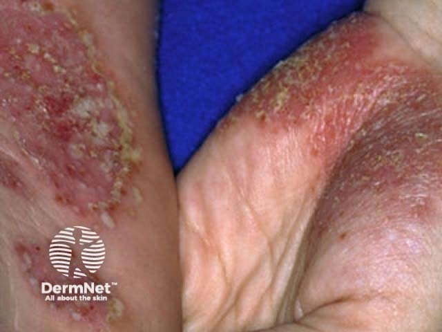 Pustular psoriasis of the hands and feet