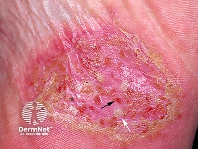 Pustular psoriasis of the hands and feet