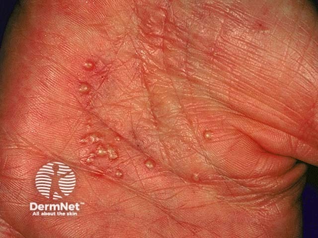 Pustular psoriasis of the hands and feet