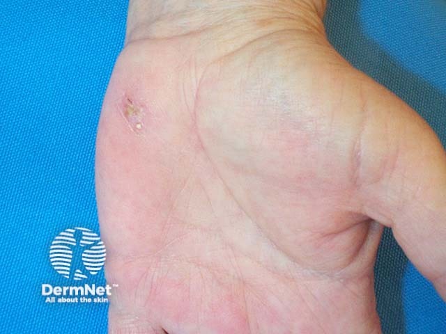 Pustular psoriasis of the hands and feet