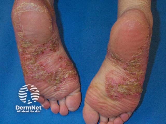 Pustular psoriasis of the hands and feet