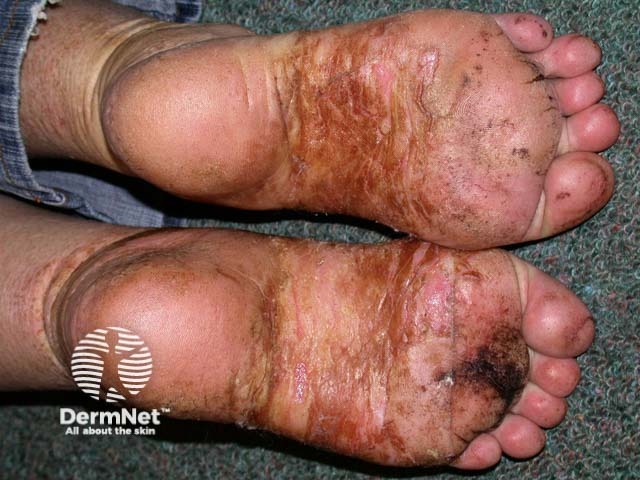 Pustular psoriasis of the hands and feet