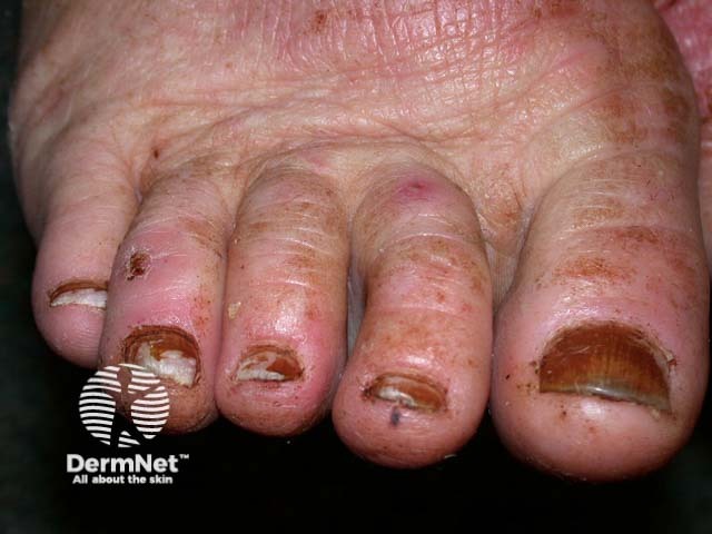 Pustular psoriasis of the hands and feet