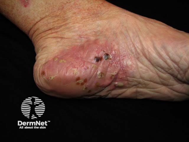 Pustular psoriasis of the hands and feet