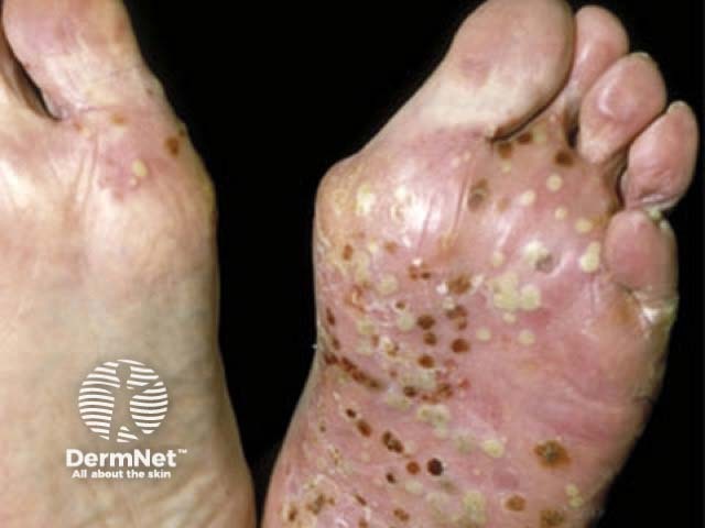 Pustular psoriasis of the hands and feet