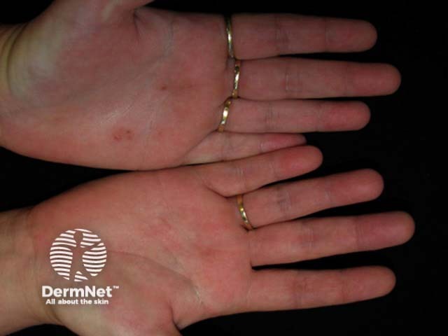 Pustular psoriasis of the hands and feet