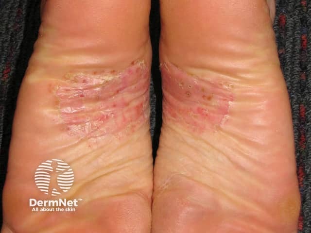 Palmoplantar pustulosis