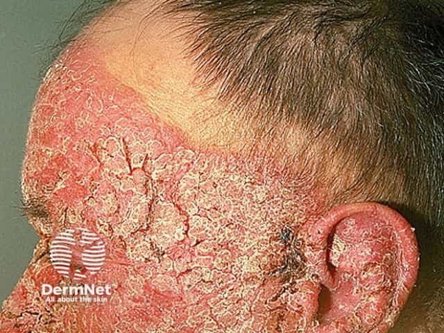 Facial psoriasis