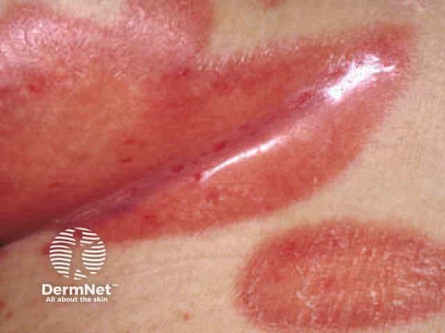 Flexural psoriasis