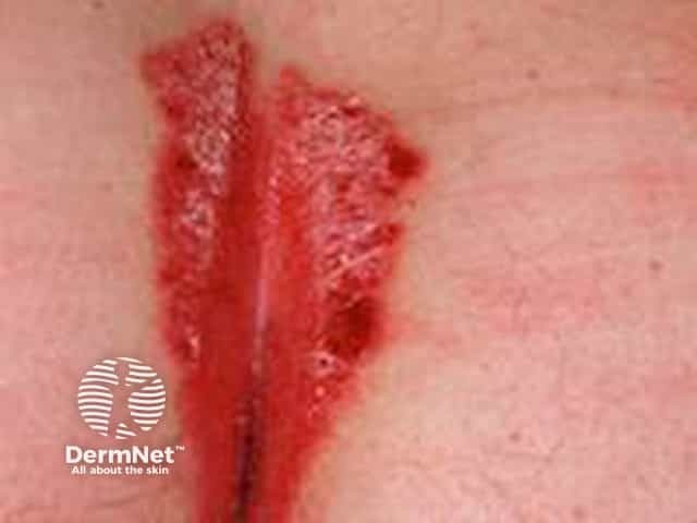 Flexural psoriasis