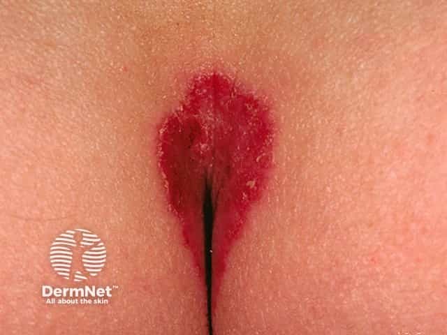 Flexural psoriasis