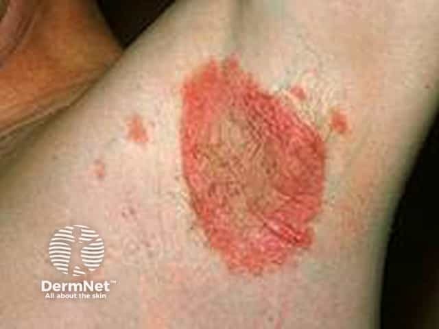 Flexural psoriasis