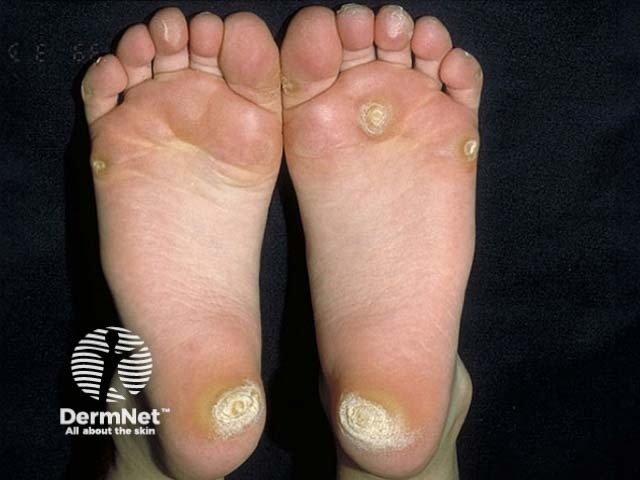 Focal palmoplantar keratoderma