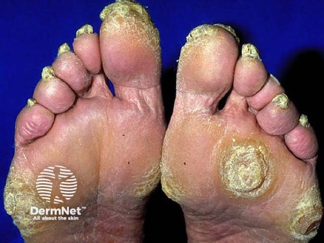 Focal palmoplantar keratoderma