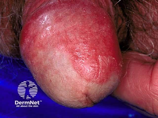 Genital psoriasis