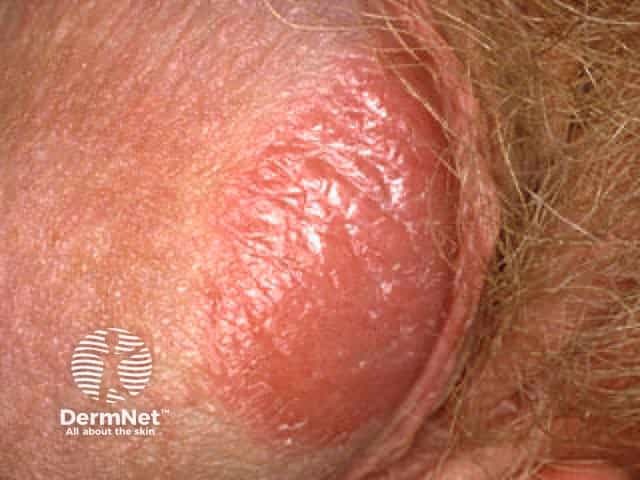 Genital psoriasis