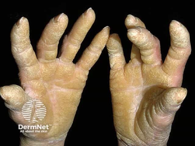 Diffuse palmoplantar keratoderma