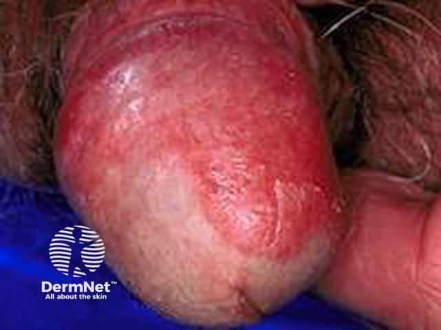 Penile psoriasis