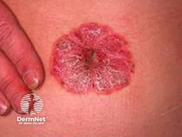 Umbilical psoriasis