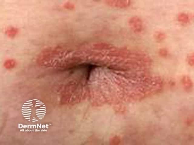 Umbilical psoriasis