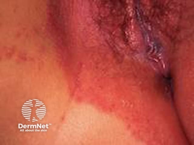 Vulval psoriasis