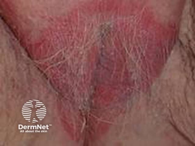 Vulval psoriasis