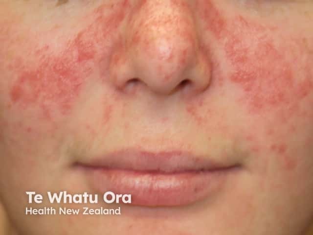 Facial psoriasis