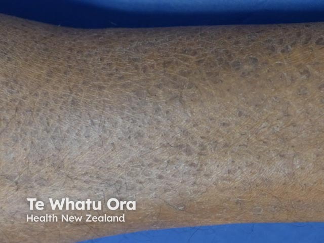 Ichthyosis vulgaris